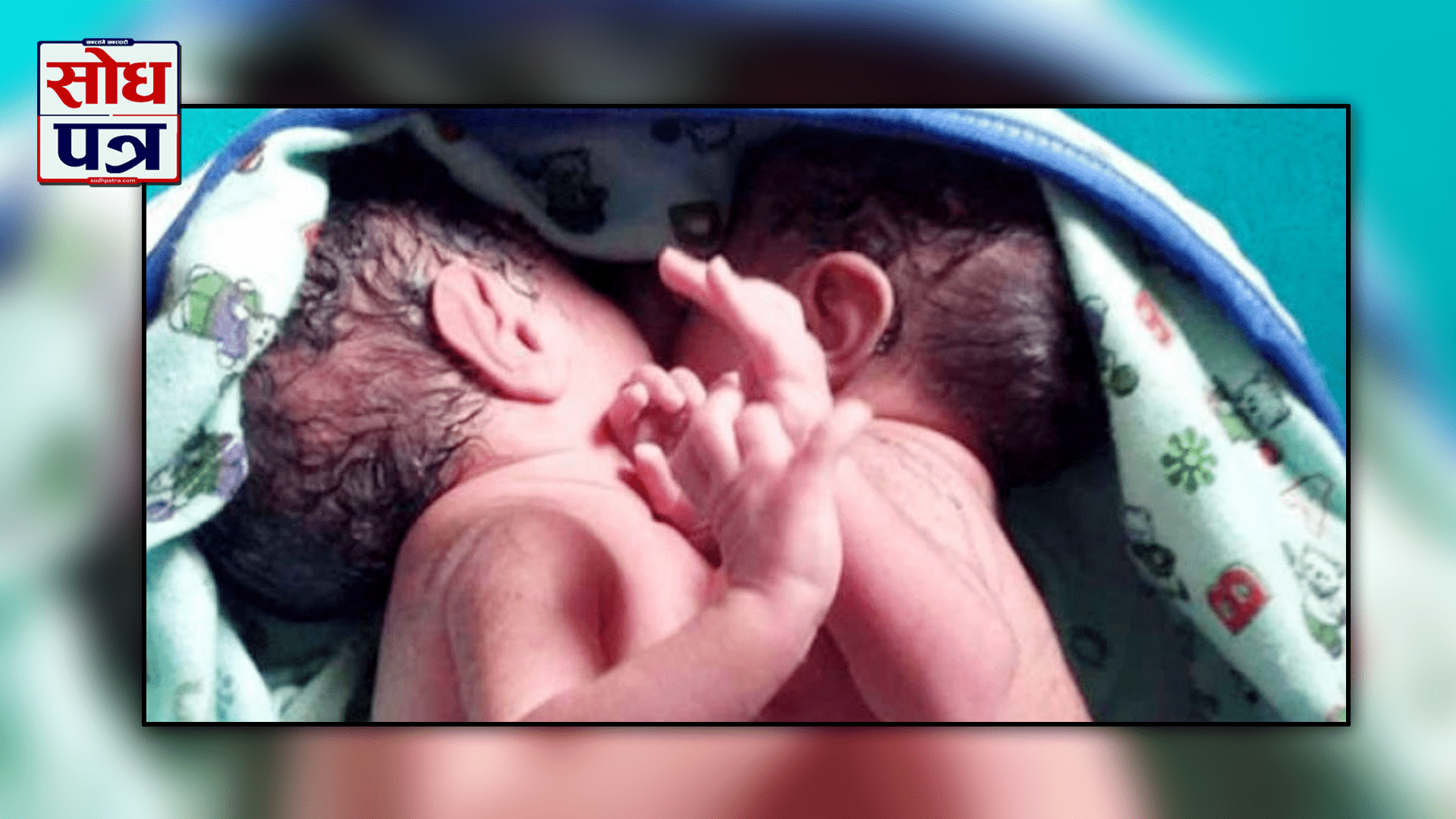 जन्मीए शरीर जोडिएका दुई शिशु