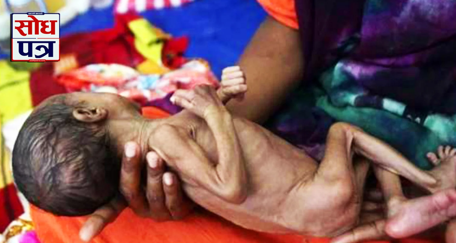 कुपोषित बालबालिका